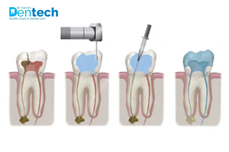 Root Canal Treatment in Thane, Mumbai